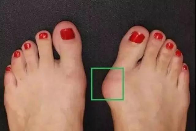 上海健桥医院拇外翻侯明主任正常脚型和拇外翻对比