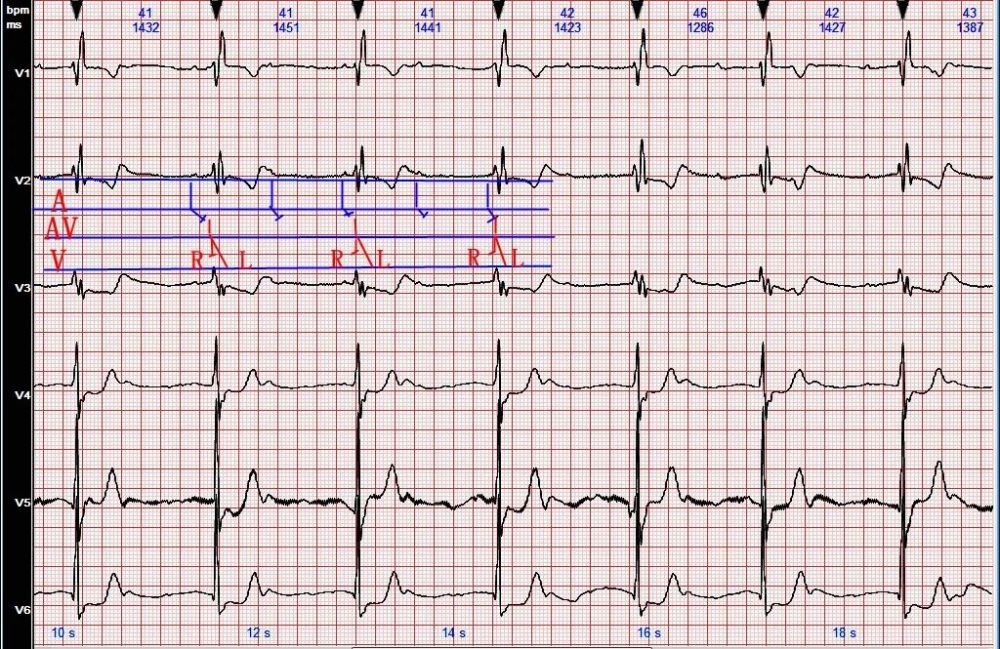 心电图病例分析1三度房室传导阻滞交界性逸搏心律伴完全性右束支阻滞