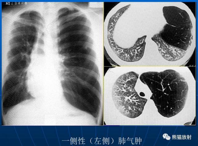 【x线诊断要点】关于"肺气肿"的一些概念,需要熟悉(结合ct)