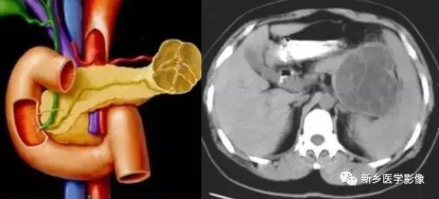 黏液性囊腺瘤|腫塊|腫瘤|胰腺腫瘤|胰腺囊性腫瘤