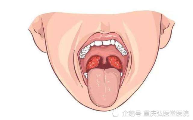 查看可見咽部充血,扁桃體腫大且有膿點.