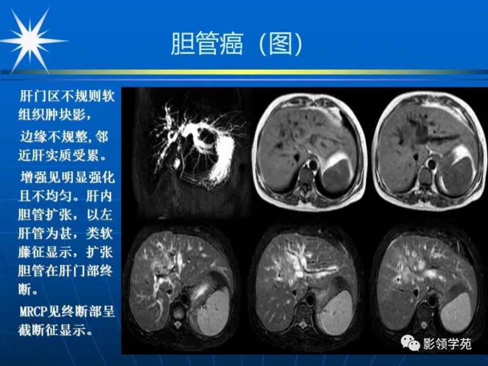 膽道系統疾病影像診斷