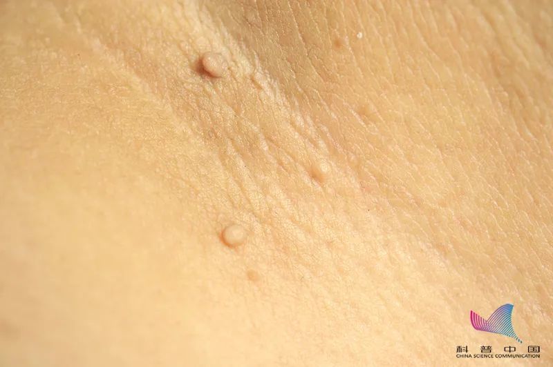 身上莫名长出的小揪揪皮肤病还是hpv感染了这篇文章全说清了