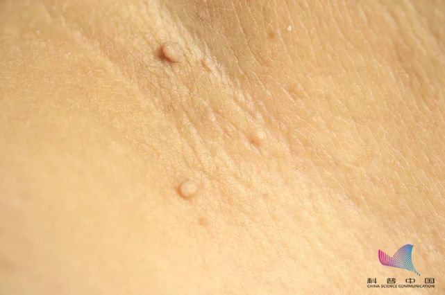 身上莫名长出的小揪揪皮肤病还是hpv感染了这篇文章全说清了