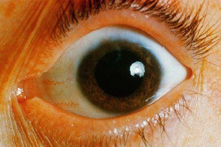 病理性飞蚊症能不能治愈