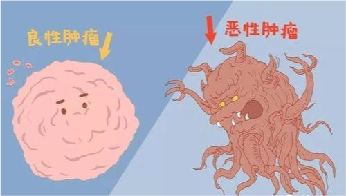 你瞭解惡性腫瘤的一般表現嗎