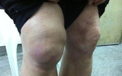 什么是膝关节滑膜炎日常生活中如何预防