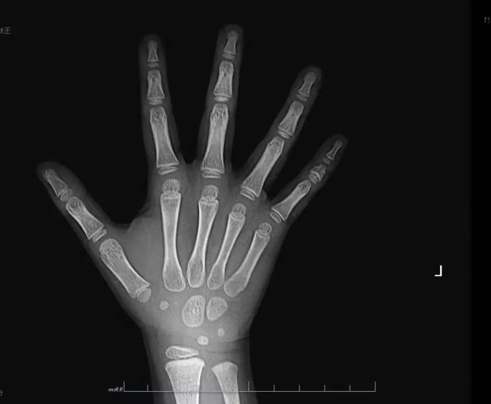 柳州家长柳州市潭中人民医院22号免费拍骨龄不限名额快来报名