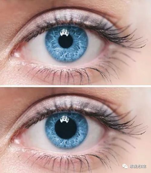瞳孔颜色变化提示着什么