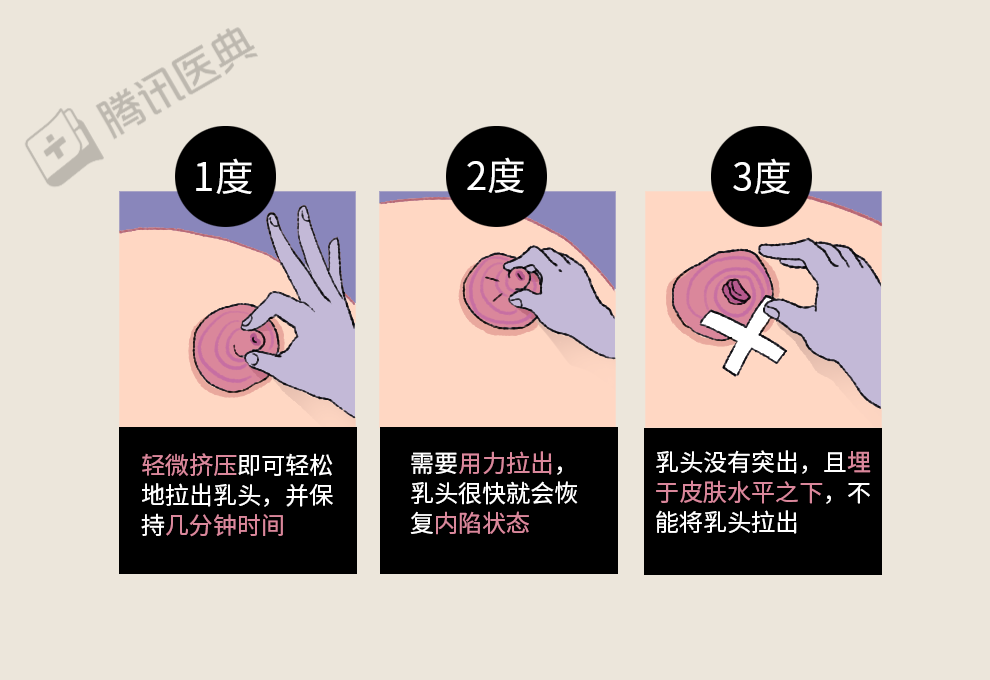 乳房長了小疙瘩,正常嗎?這4種變化,真的不用擔心!_騰訊新聞