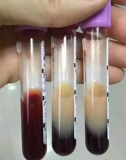 一女子血液变奶茶色,住进icu!最近很多人都在做这事