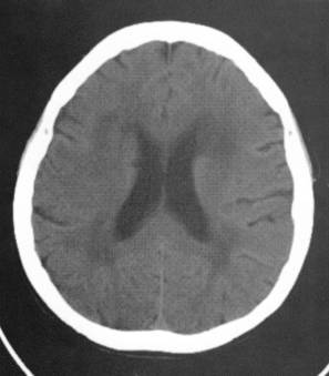 平扫脑室旁和半卵圆中心大片状白质密度减低,边缘模糊不清,伴有脑深部