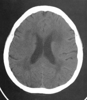 3种常见脑白质病ct表现
