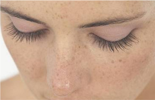 热腾腾!孕期黄褐斑"怎么受孕"-第1张图片-金凯博客