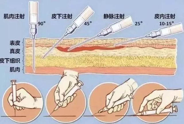 试管助孕药物达必佳01自行注射方法
