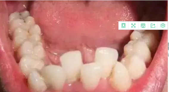 智齿形状正常,是阻生牙.