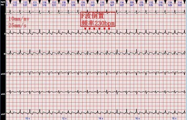 心电图图例分析2i型心房扑动呈21房室传导