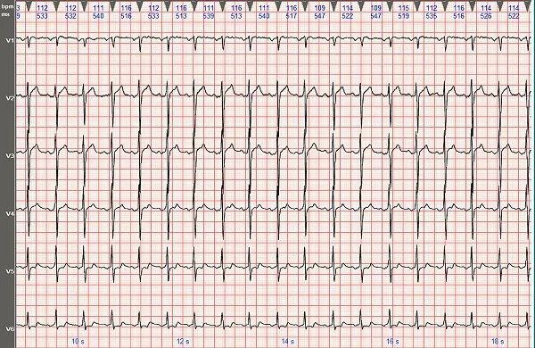 心電圖圖例分析2:i型心房撲動呈2:1房室傳導