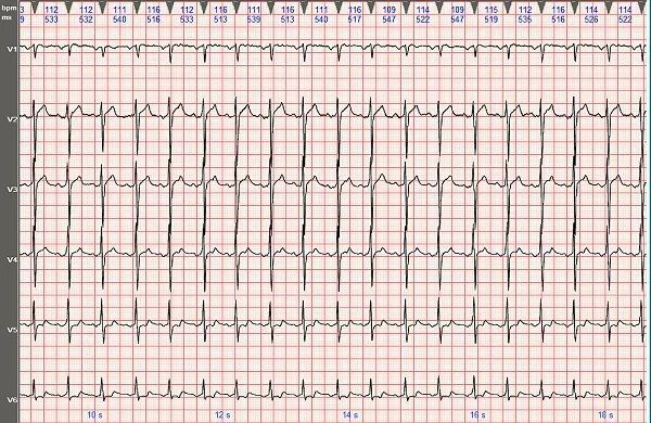 心电图图例分析2i型心房扑动呈21房室传导