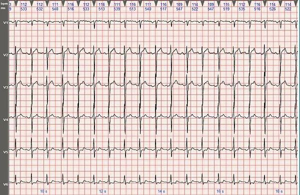 心电图图例分析2i型心房扑动呈21房室传导