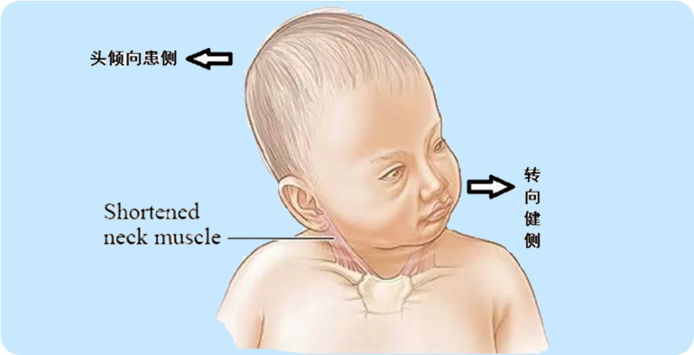 脑瘫患儿为什么会出现斜颈