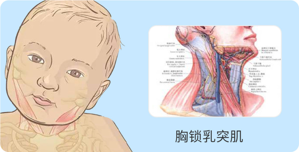 一般常见的主要是肌性斜颈,是由于颈椎的椎体错位,一侧胸锁乳突肌纤维