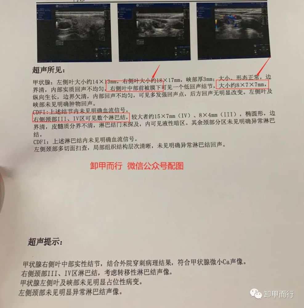 607不同情況下07cm甲狀腺癌淋巴結轉移情況對照分析觀察群收藏版上