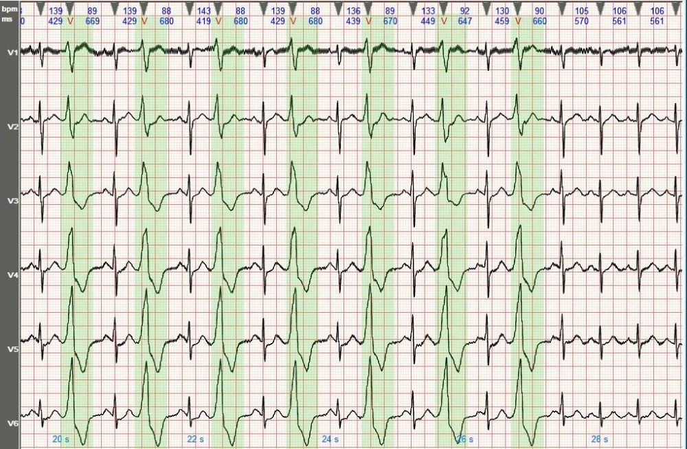 心电图图例分析3室性早搏呈二联律