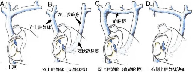 笔记分享永存左上腔静脉