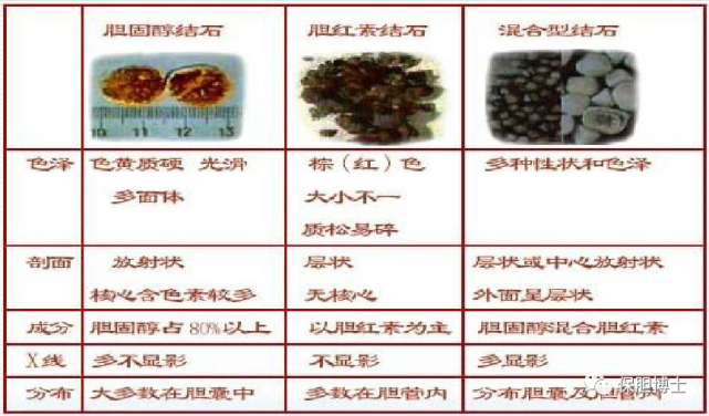 怎么知道自己得了胆固醇结石还是胆色素结石?