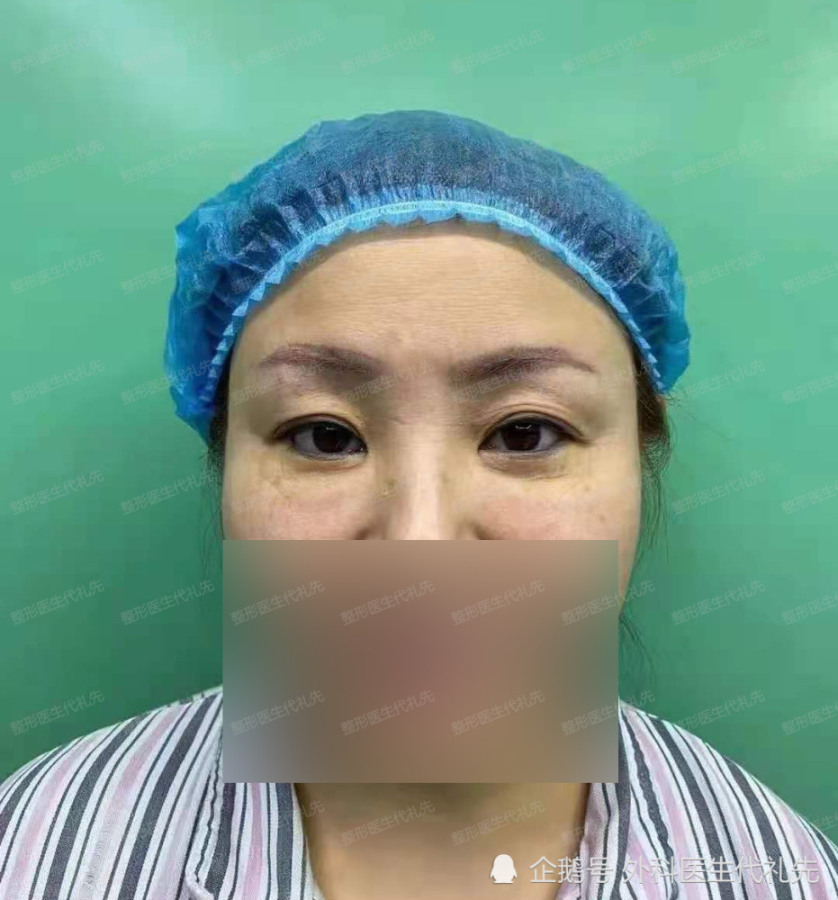 筋膜悬吊提眉手术外切去眼袋眼周小拉皮手术