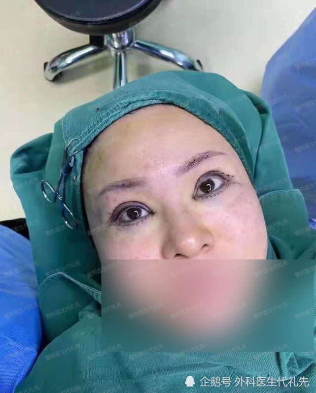 筋膜悬吊提眉手术外切去眼袋眼周小拉皮手术