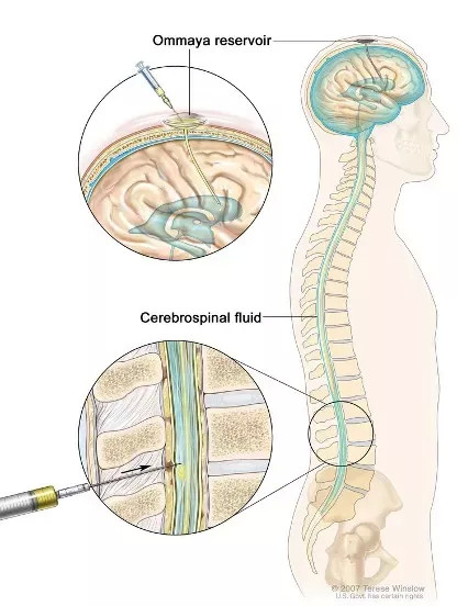 鞘内注射示意图图片