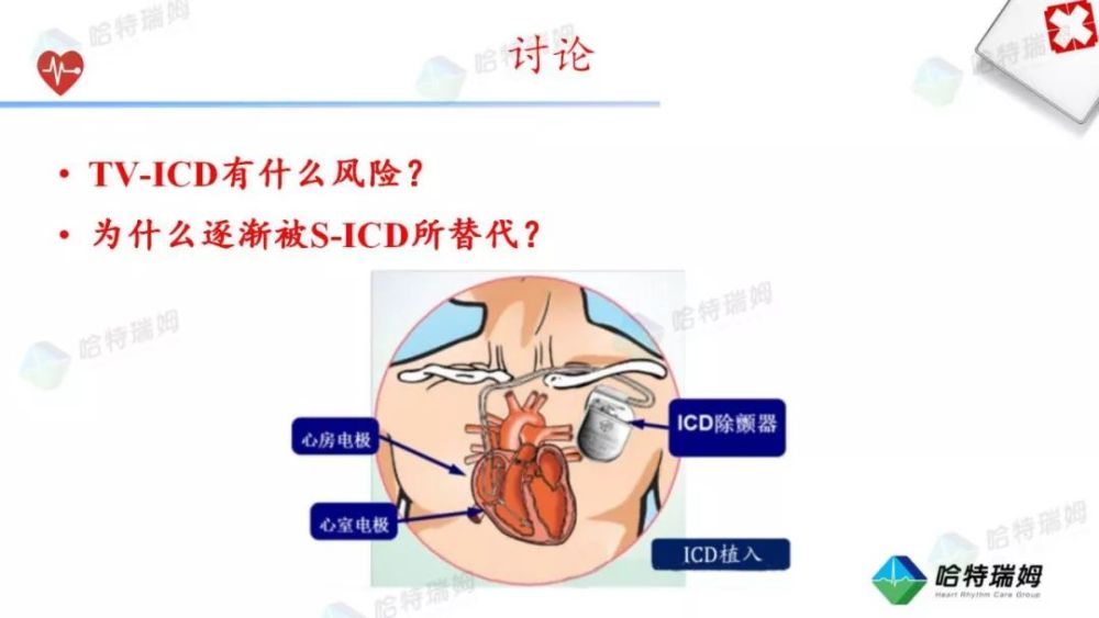 術中將s-icd發生器和導線位置放置好後,進行除顫閾值測試,1次65j電擊