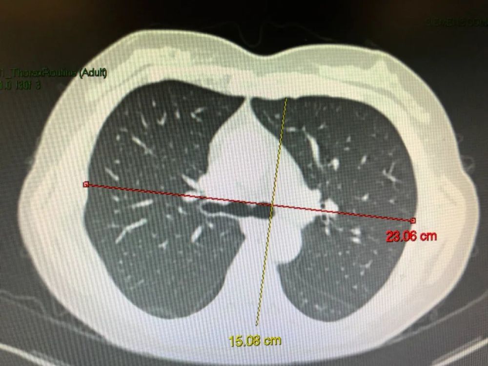慢阻肺患者的肺为何会变成桶状的出现桶状胸意味着什么