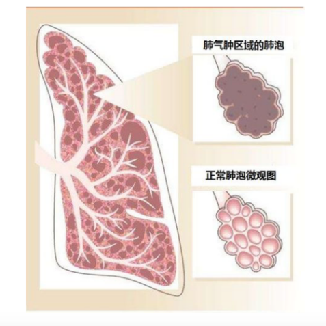 慢阻肺患者的肺为何会变成桶状的出现桶状胸意味着什么