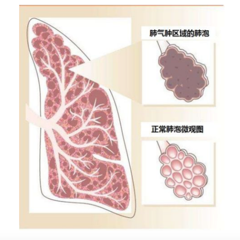 慢阻肺桶状胸图片