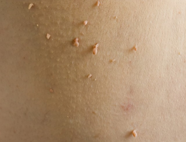 31岁女主管身上长出"小疙瘩",医生:别以为是过敏,可能是hpv报道了