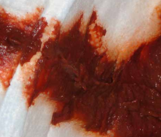 孩子为什么血便了元凶原来是它