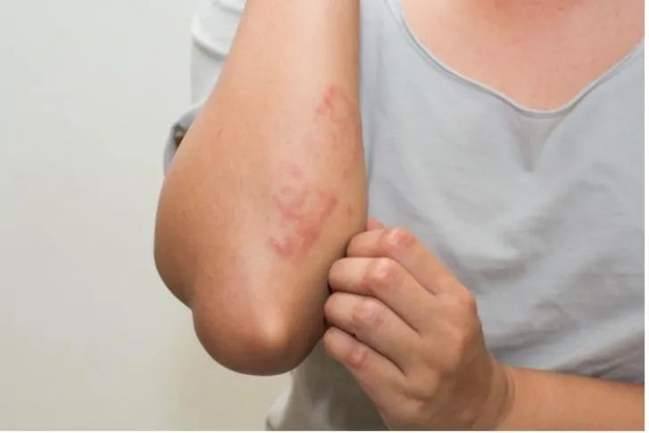 皮肤红疹同样多数是由过敏引起,所以这两种情况都不适宜用红霉素软膏
