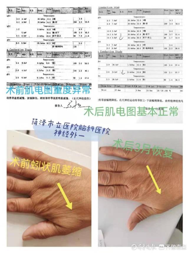 菏泽市立医院脑科医院神经外科成功治疗周围神经疾病患者