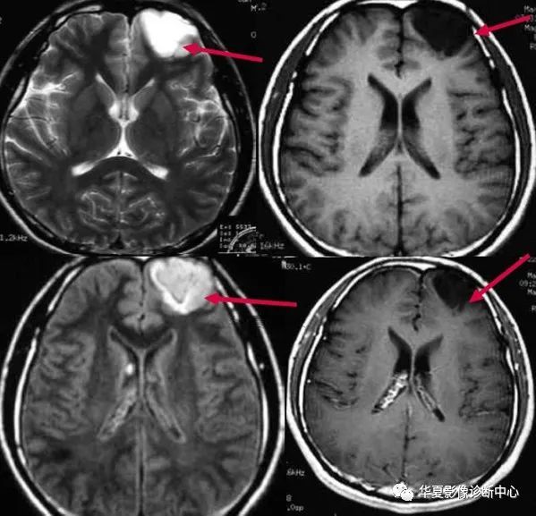 右侧颞叶软化灶图片