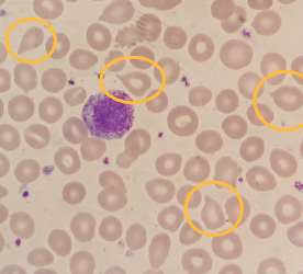 血红原因蛋白偏低细胞会高吗_血红蛋白低红细胞低怎么回事_血红细胞血红蛋白偏低的原因