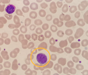 从mdsmpn到pmf小巨核细胞带来的思考