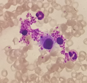 从mdsmpn到pmf小巨核细胞带来的思考