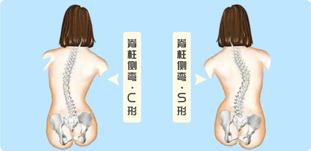 腦癱與脊柱側彎的關係您清楚嗎