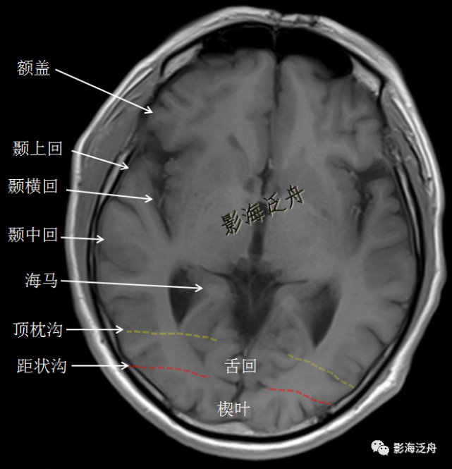 颞叶横断面图片