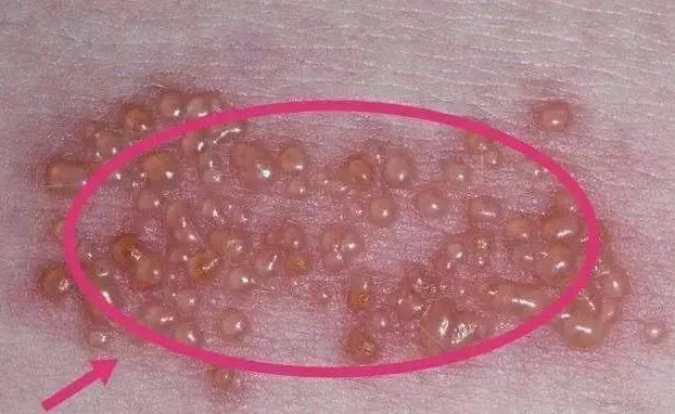 ▼密恐人群可以跳过此环节带状疱疹,俗称"缠腰火丹","缠腰蛇",由"水痘