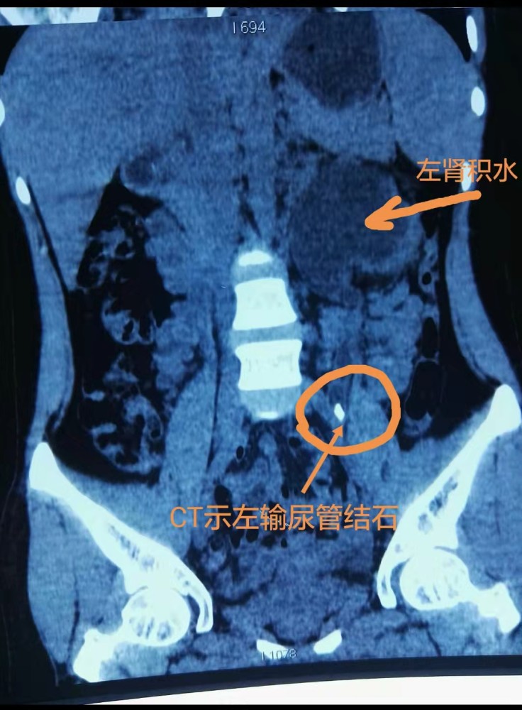 懷疑有輸尿管結石如何選擇行b超x線片和ct檢查