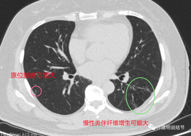 當然也可能不典型增生,可安全年度隨訪;病灶8:左肺下葉淡磨玻璃影